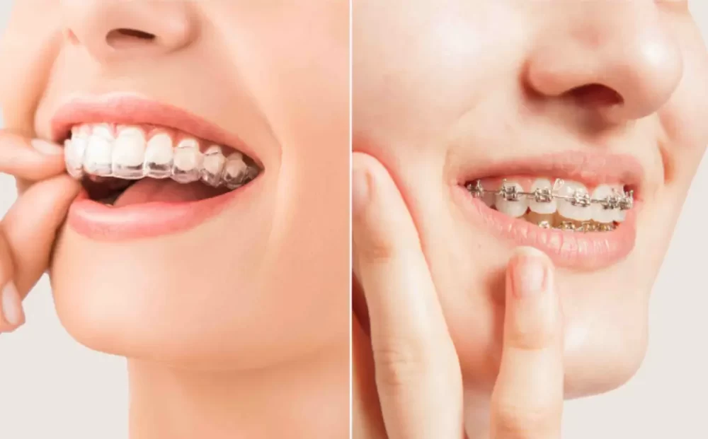 braces-and-aligners