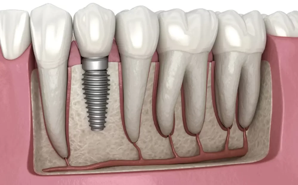 dental-implants