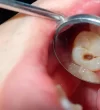 how-to-prevent-cavities-and-tooth-decay how-to-prevent-cavities-and-tooth-decay